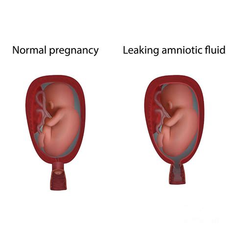 amniotic.fluid leaking|Leaking Amniotic Fluid 